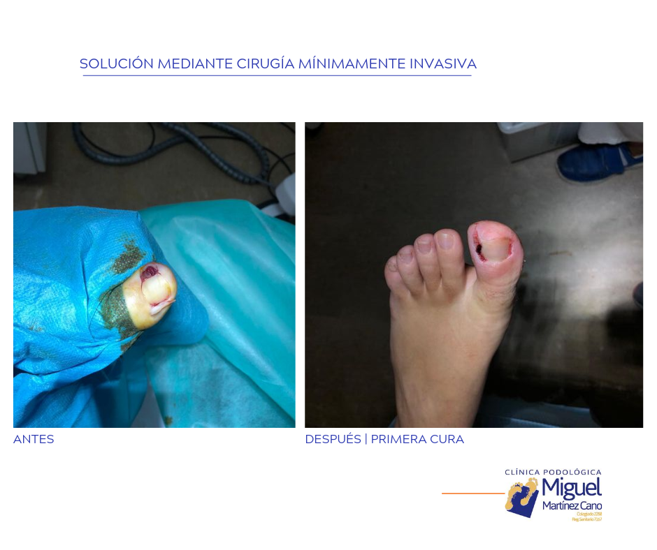 Antes y después de intervención de cirugía en dedo de pie